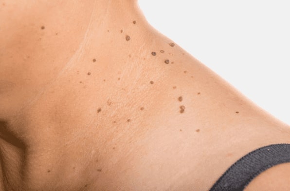 Are you looking for easy skin tag removal Pudsey - then contact Spire today!