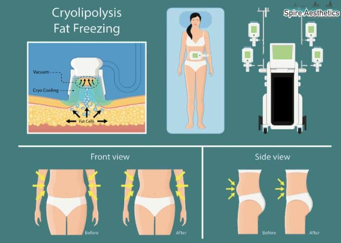 Image of diet and fat freezing combined for best results for Spire Aesthetics Pudsey
