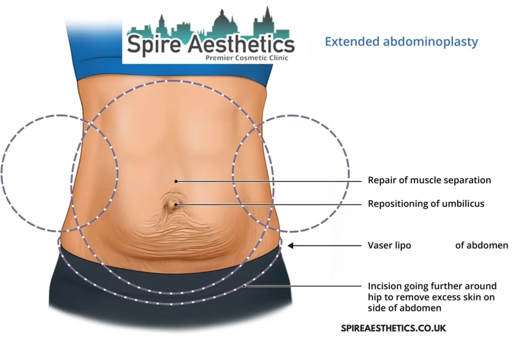 Understanding Loose Skin After Gastric Band Pudsey Surgery and HIFU Treatment
