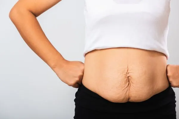 Image of a woman's stomach after weight loss with sagging skin following a gastric band Pudsey