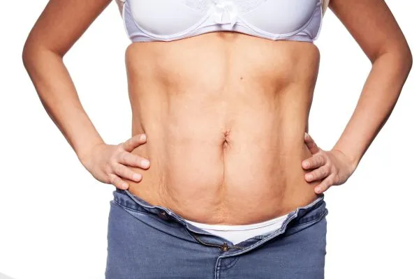 sagging skin on woman's stomach after weight loss injections Pudsey