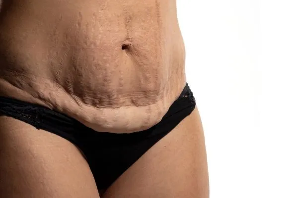 Image of womans stomach after weight loss injections Pudsey showing saggy skin